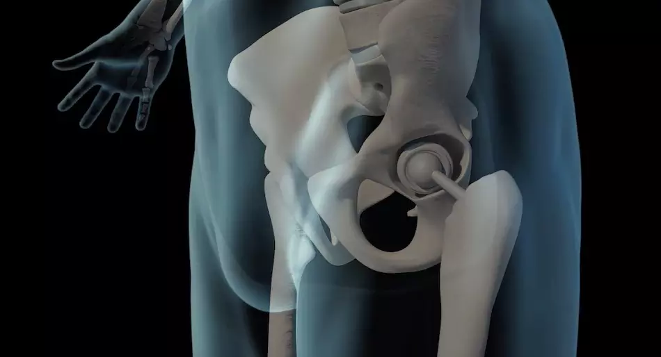 El reemplazo de cadera, un procedimiento médico que tiene como objetivo mejorar la calidad de vida de las personas que sufren de problemas en la articulación de la cadera.