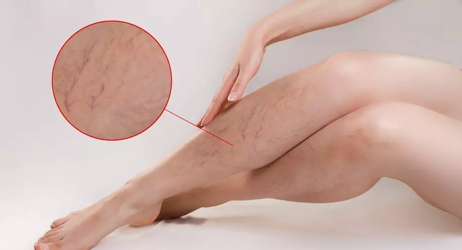 ¿Qué son las varices y cómo se tratan? 