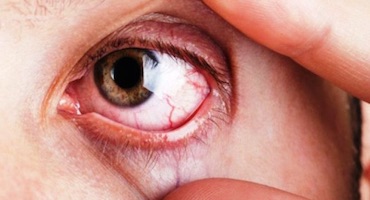 Qué es el glaucoma?