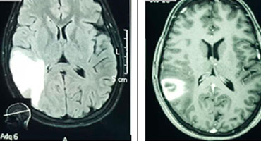 Cerebral venous sinus thrombosis